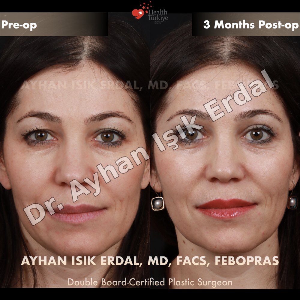 Blepharoplasty before-and-after result by Dr. Ayhan Işık Erdal, Istanbul