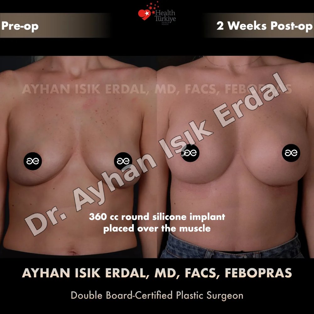 Breast Augmentation before-and-after result by Dr. Ayhan Işık Erdal, Istanbul