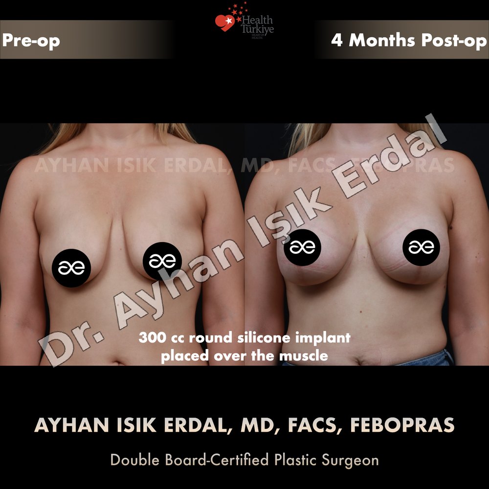 Breast Lift before-and-after result by Dr. Ayhan Işık Erdal, Istanbul