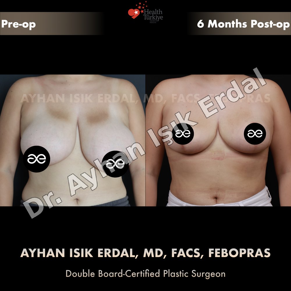 Breast Reduction before-and-after result by Dr. Ayhan Işık Erdal, Istanbul