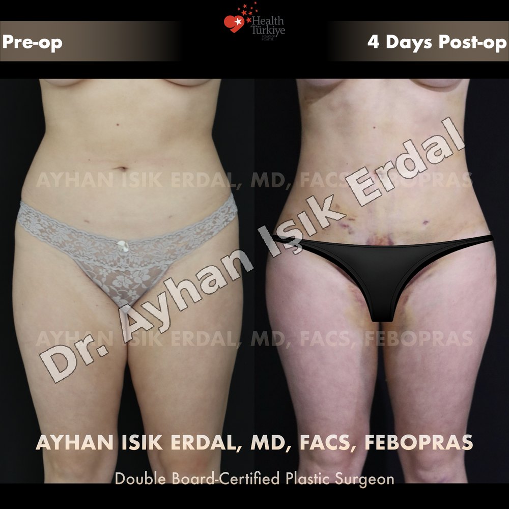 Liposuction before-and-after result by Dr. Ayhan Işık Erdal, Istanbul