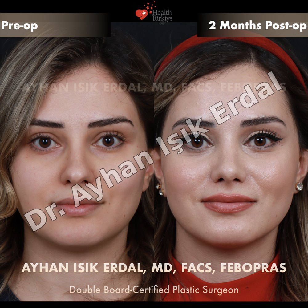 Revision Rhinoplasty before-and-after result by Dr. Ayhan Işık Erdal, Istanbul