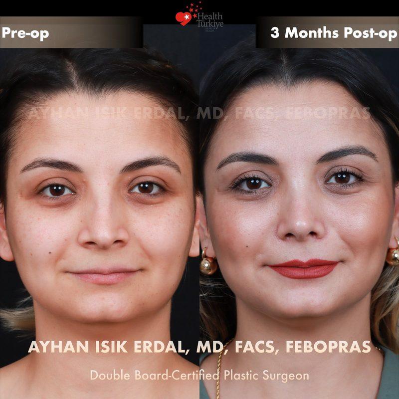 Rhinoplasty before-and-after result by Dr. Ayhan Işık Erdal, Istanbul