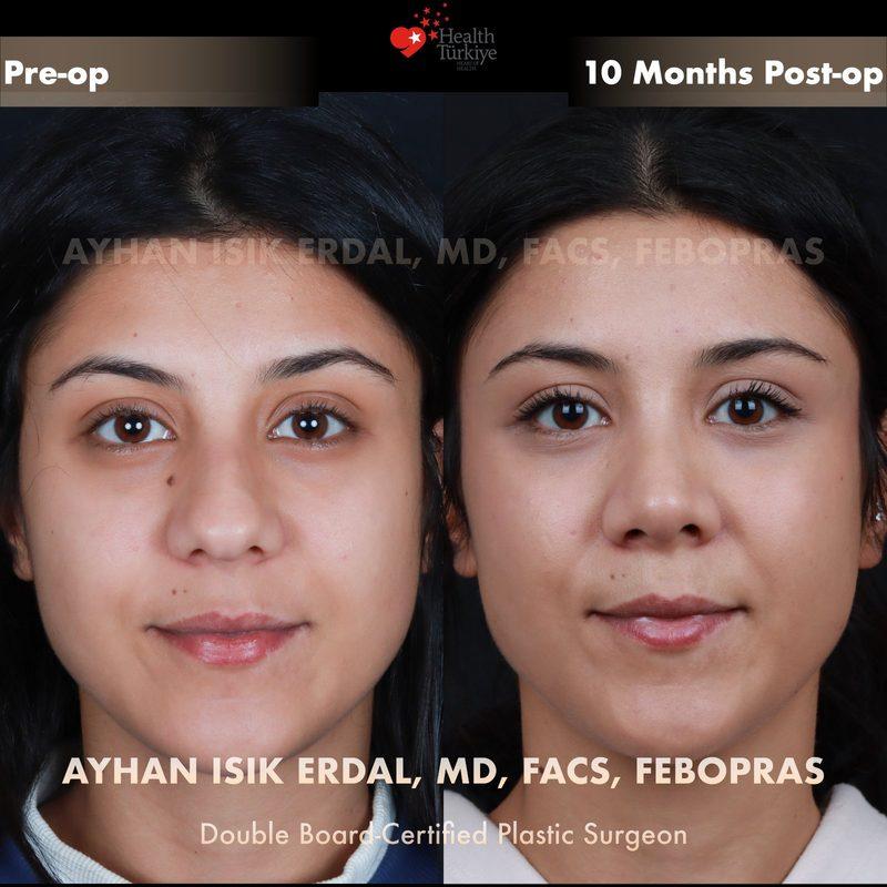 Rhinoplasty before-and-after result by Dr. Ayhan Işık Erdal, Istanbul