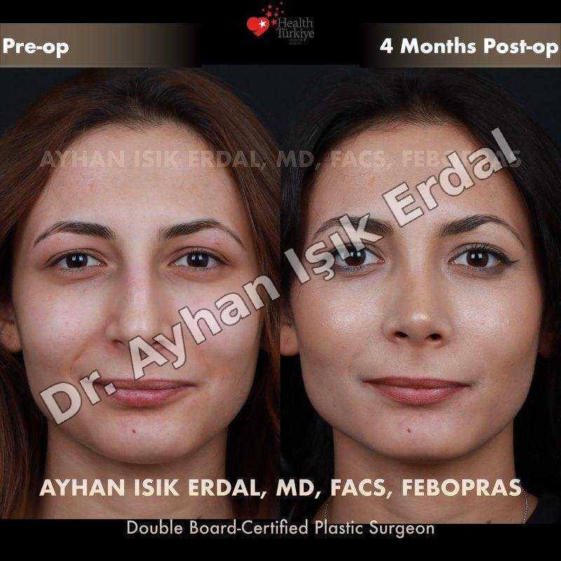 Rhinoplasty before-and-after result by Dr. Ayhan Işık Erdal, Istanbul
