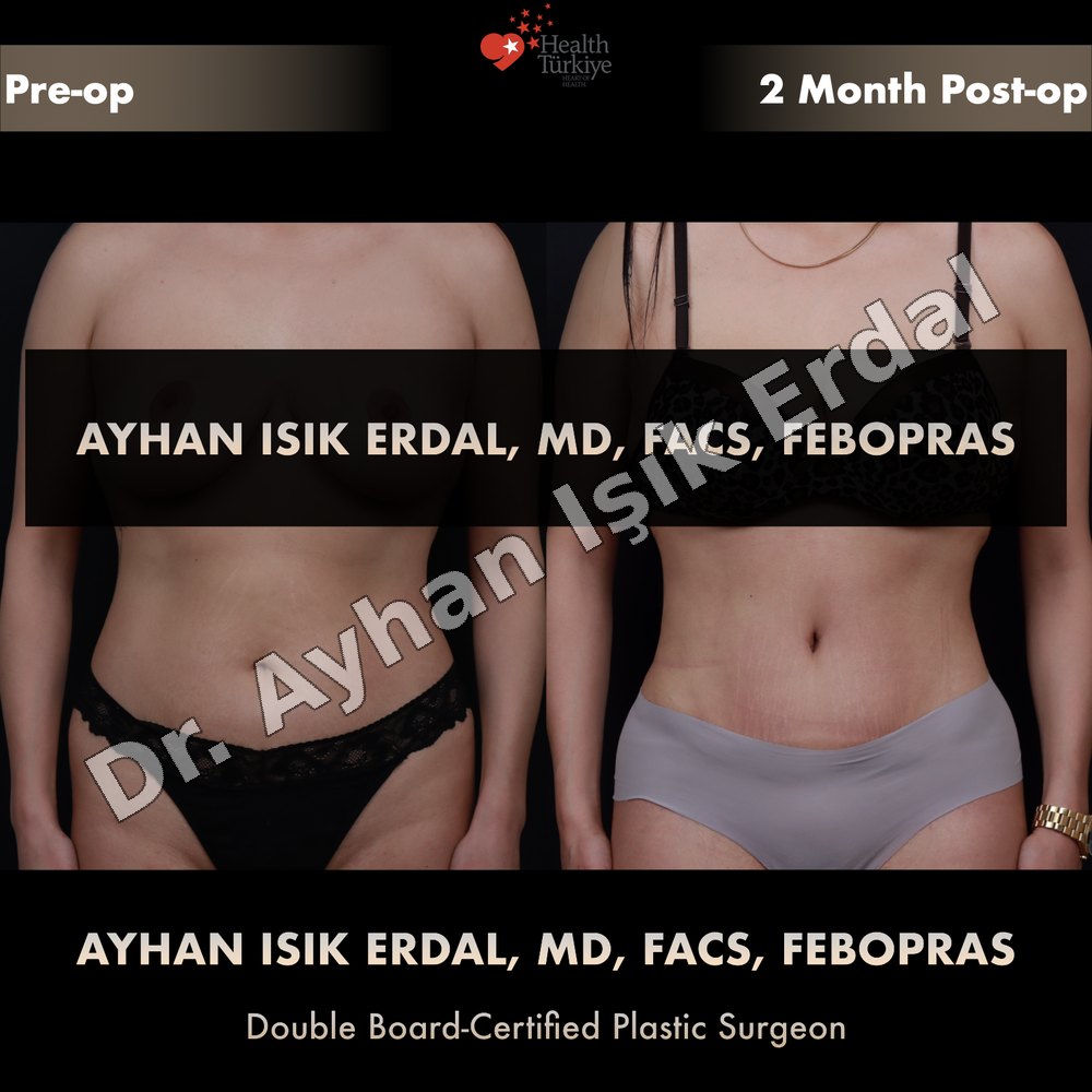 Tummy Tuck before-and-after result by Dr. Ayhan Işık Erdal, Istanbul